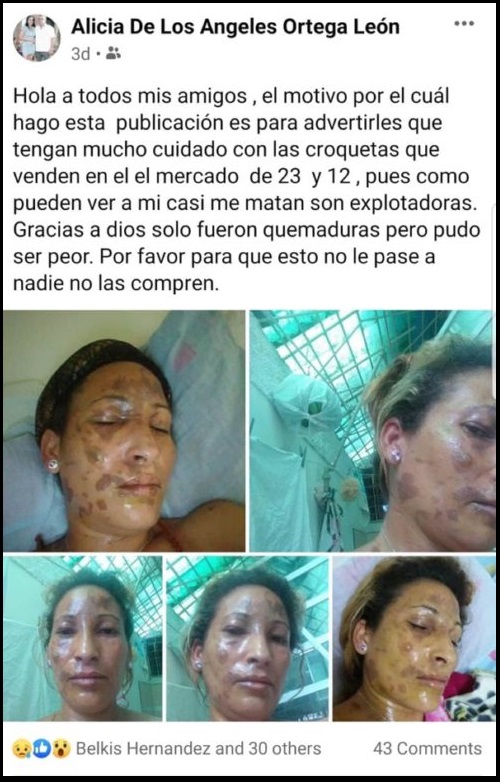 Cubana termina con quemaduras en la cara causadas por croquetas explosivas