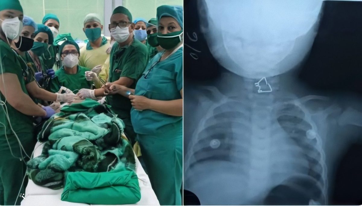 Equipo médico de Holguín salva a bebé que se tragó un objeto peligroso (2)