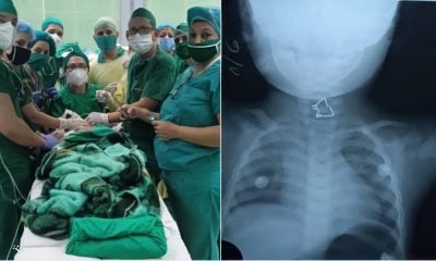 Equipo médico de Holguín salva a bebé que se tragó un objeto peligroso (2)