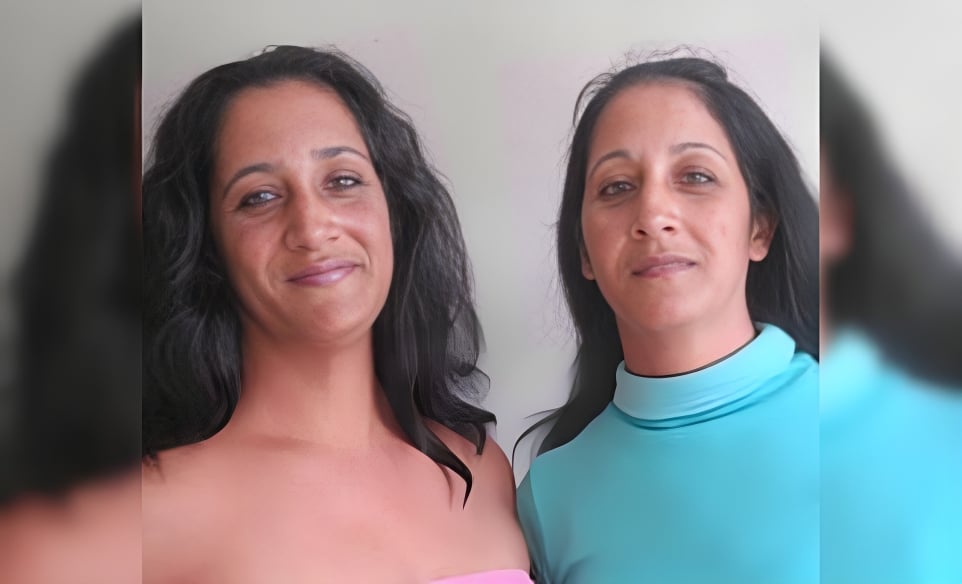 Las siamesas cubanas celebran 50 años tras histórica separación quirúrgica en la Isla (1) (2)