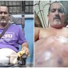 Cubano con enorme hernia suplica ayuda ante negativa de cirugía en hospitales de la Isla