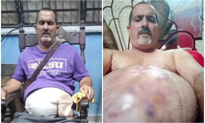 Cubano con enorme hernia suplica ayuda ante negativa de cirugía en hospitales de la Isla