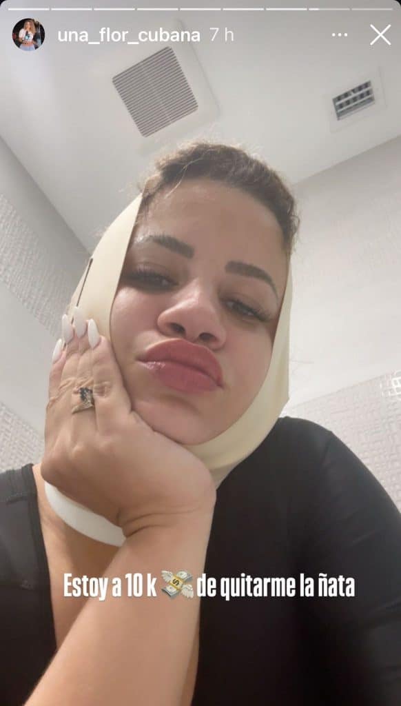 Flor de Cuba-rinoplastia