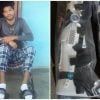 Joven de Contramaestre volverá a caminar gracias a donación de un aparato ortopédico desde Miami (1)