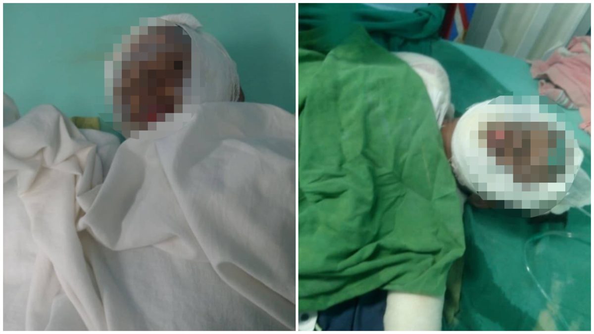Solicitan donaciones para dos niños cubanos en estado crítico por explosión de un cilindro de gas