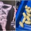 Aduana de Cuba detecta entrada de droga adosada al cuerpo de un viajero