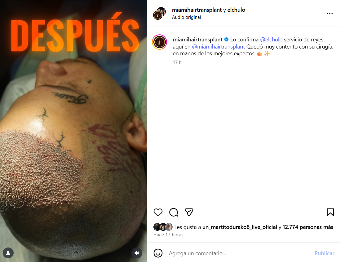 El Chulo anuncia su trasplante capilar