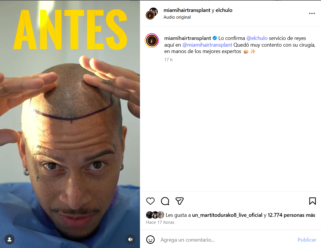 El Chulo anuncia su trasplante capilar