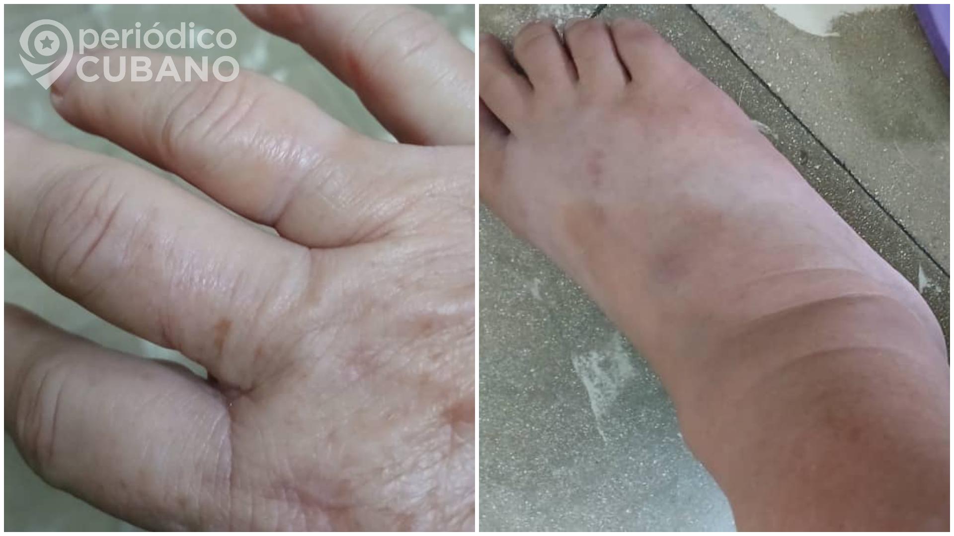 Cubana con chikungunya: “Me duelen las manos, las rodillas, cada articulación parece gritar”