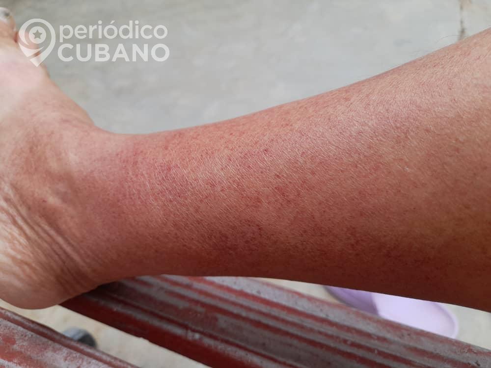 Cubana con chikungunya: “Me duelen las manos, las rodillas, cada articulación parece gritar”
