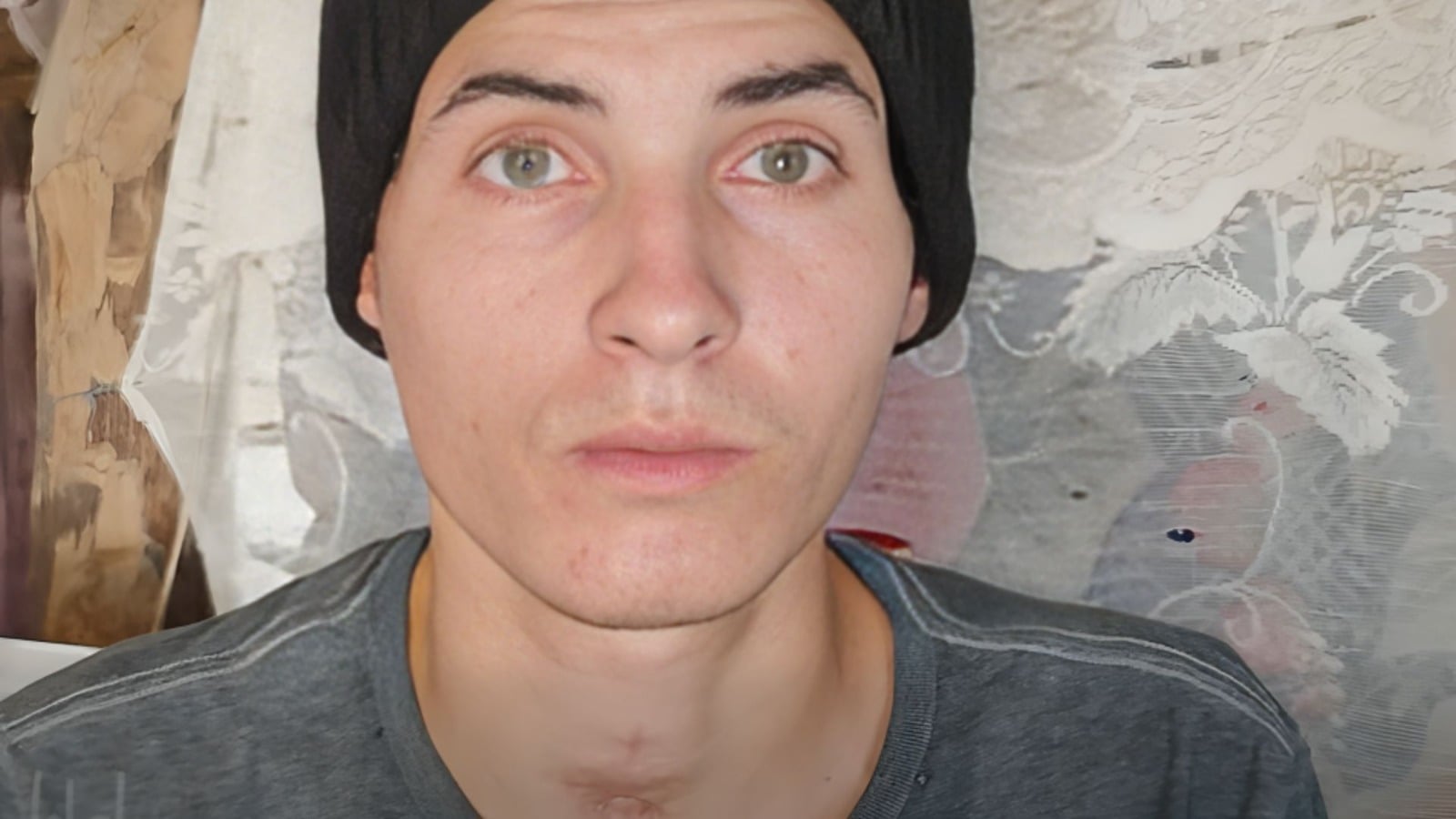 Una descarga de 33.000 voltios le cambió la vida a este joven tunero